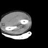 SPORK, NICO - 22.03.1976 - 02.08.2022 - CT obere Extremität - 17:56:57